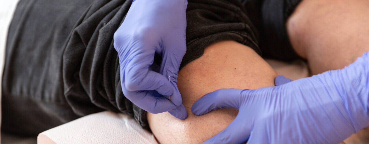 The Science Behind Dry Needling: Pain Relief through Muscular Release